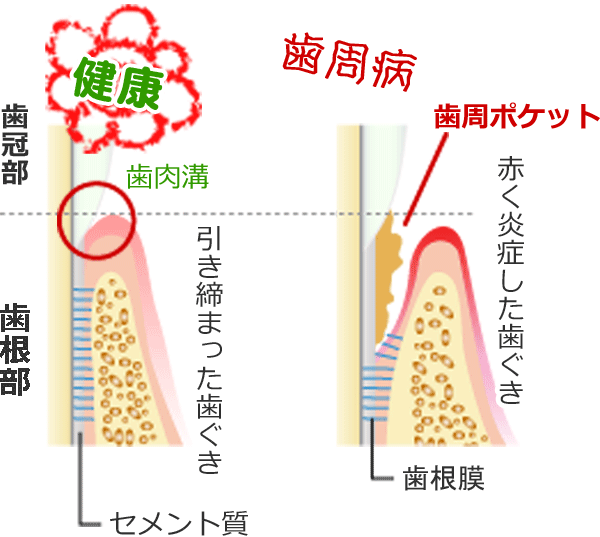 歯周病・歯槽膿漏 | 高知 安光歯科 | いの町の歯医者さん