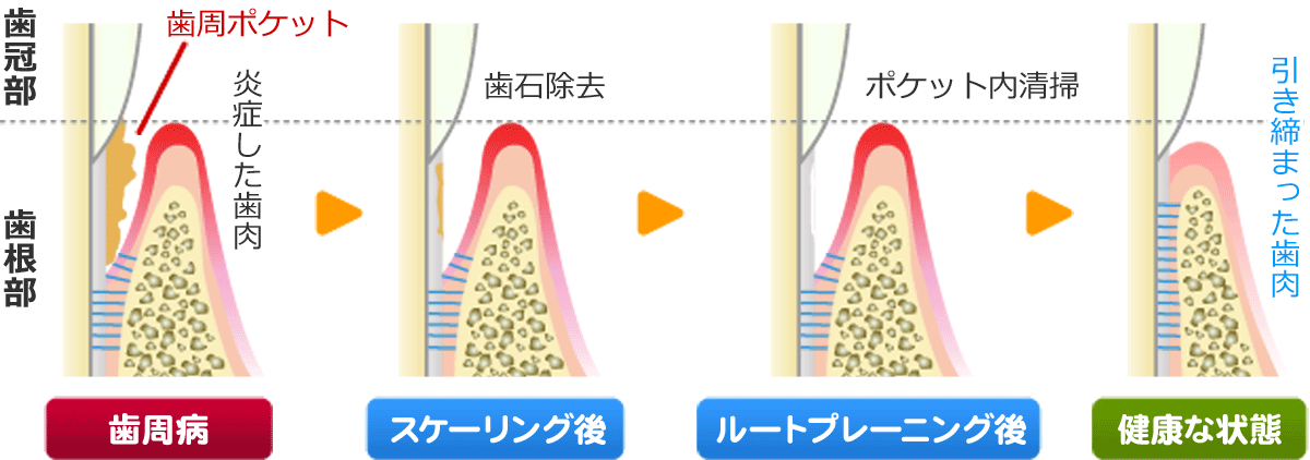 歯周病 歯槽膿漏 高知 安光歯科 いの町の歯医者さん